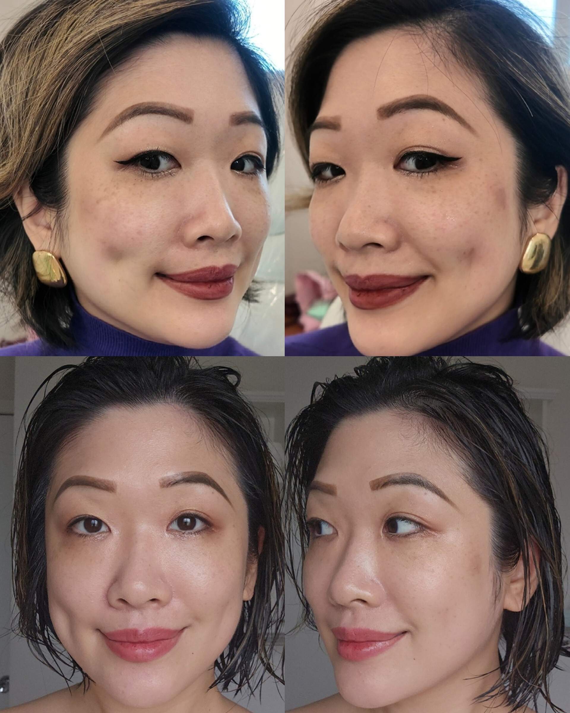 Before and after progress photos of an IPL photofacial treatment showing fading sunspots and hyperpigmentation on the cheeks.