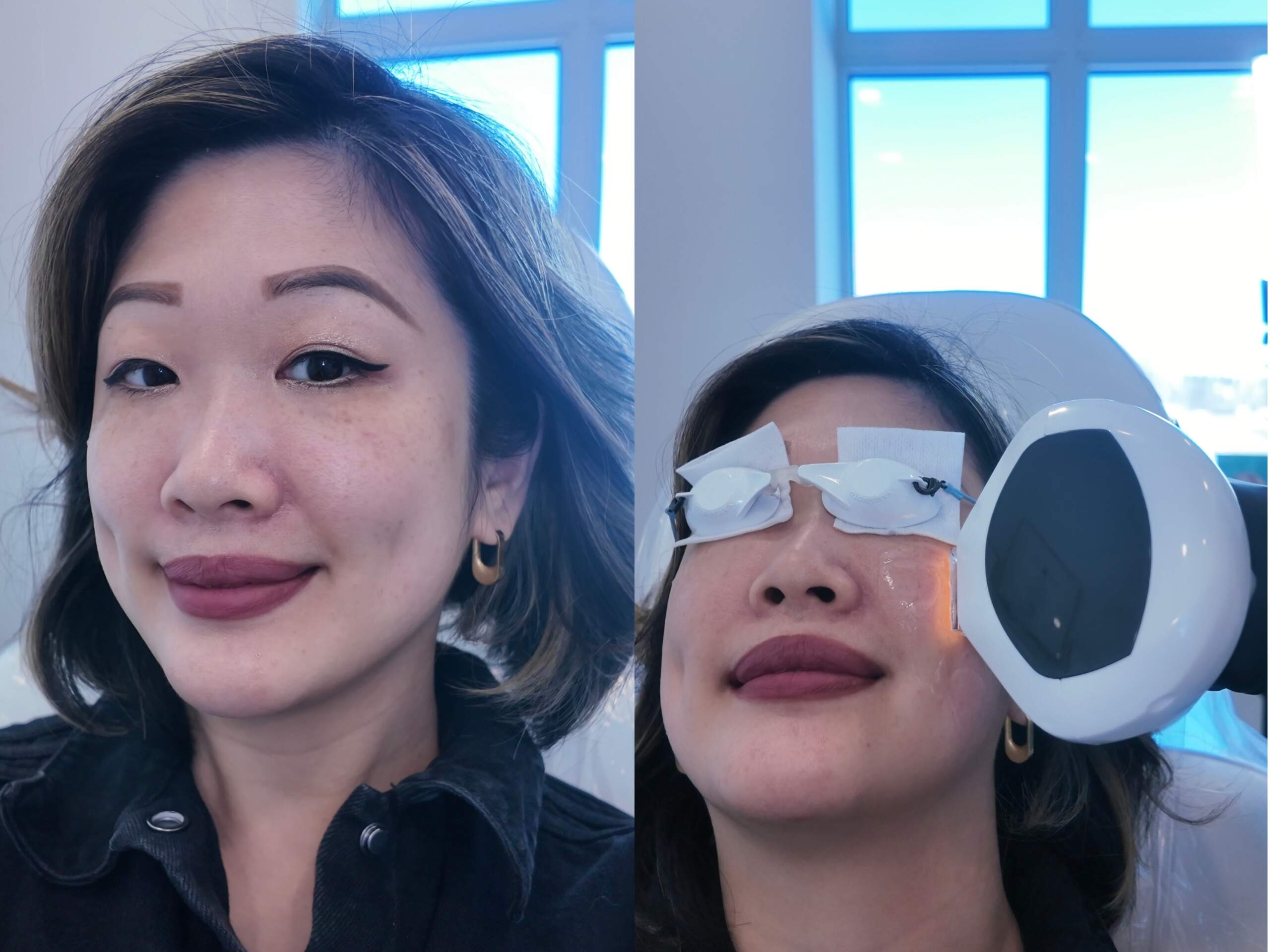 Asian   woman receiving Lumecca IPL treatment for sunspots at Genectables Cosmetic Clinic wearing protective goggles. BEauty blogger Betty 