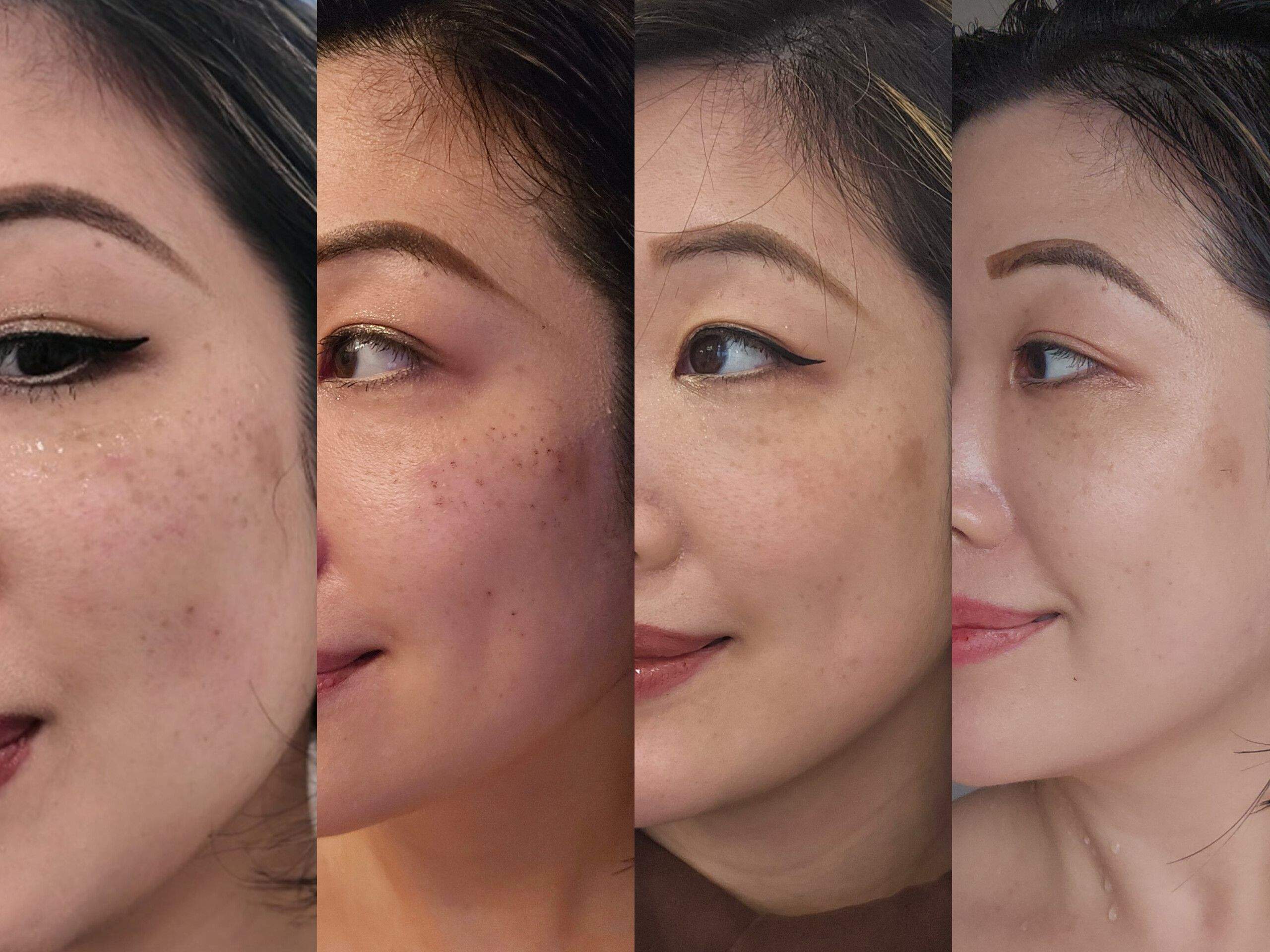 Asian woman receiving Lumecca IPL treatment for sunspots at Genectables Cosmetic Clinic wearing protective goggles.